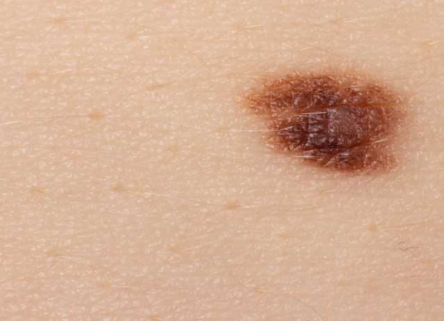 Signs of melanoma that shows uneven shape