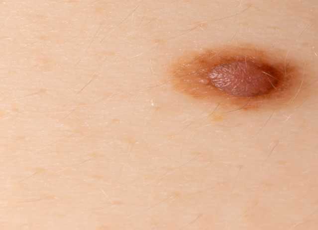 Signs of melanoma that shows uneven, ragged borders