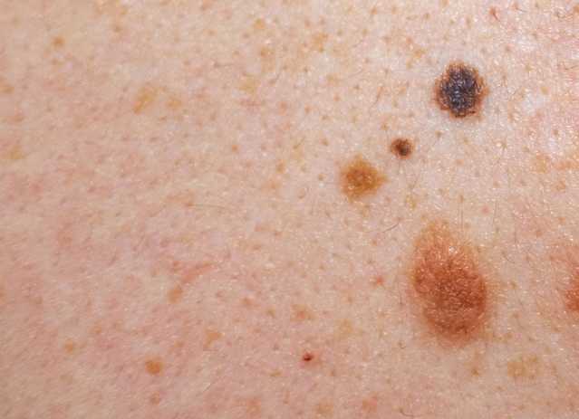 Signs of melanoma that shows two or more colours