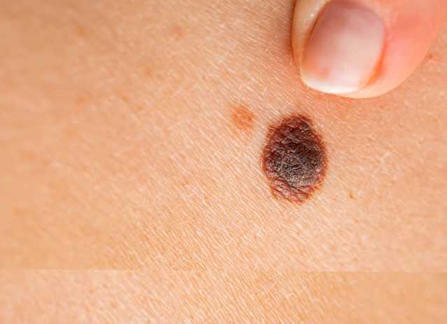 Signs of melanoma that shows size larger than a quarter inch