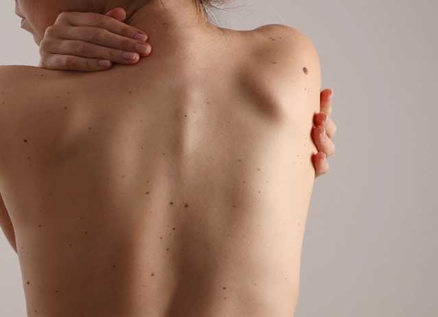 Person's bare back with moles and a statement on melanoma